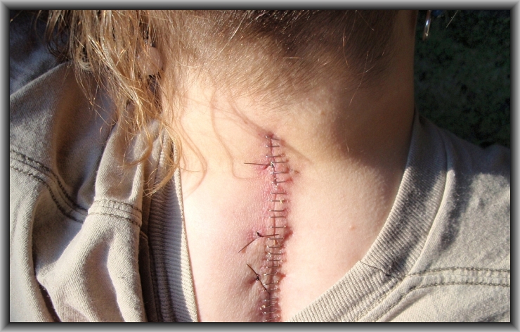 Neck Surgery Staples by Crystal A Murray as Flickr User CrystalWriter, CC License = Attribution, Noncommercial, Share Alike